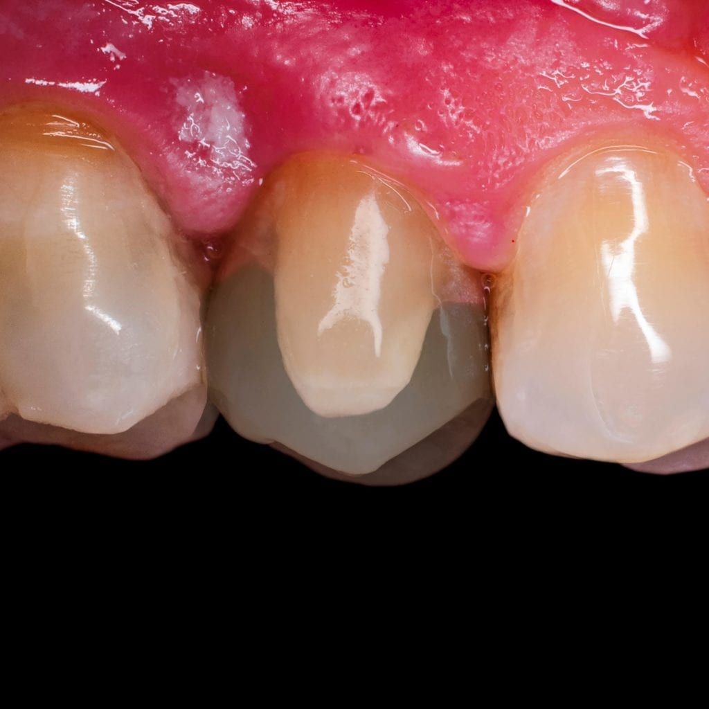 veneer being placed over oddly shaped tooth