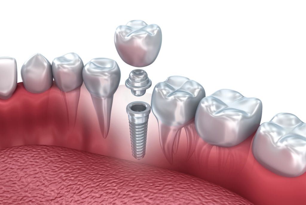 Dental implant shown in mouth
