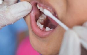 Child getting Silver Diamine Fluoride Treatment