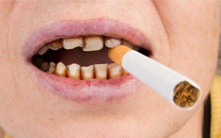 Teeth damaged by tobacco use