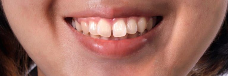 Woman with misaligned buck teeth