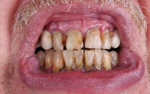 Mouth showing periodontal disease