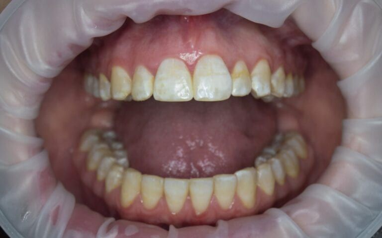 Teeth with yellow stains from excessive fluoride consumption
