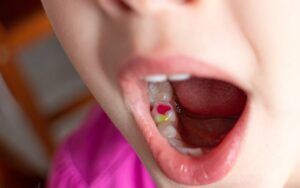 Child Dental Cavity Fillings
