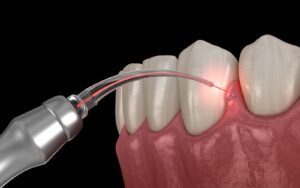 Dental Laser Gum Treatment Vector Image