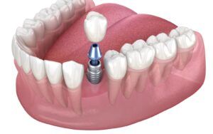 Dental Implant Model Up Close